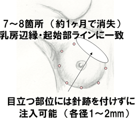 脂肪・幹細胞分散注入時の針跡