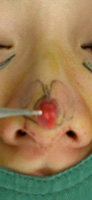 鼻尖軟骨切除