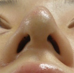 鼻尖軟骨切除 AFTER